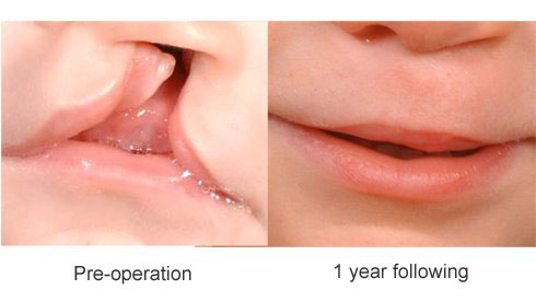 cleft lip palate repair