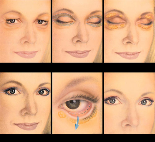 Eyelid Surgery