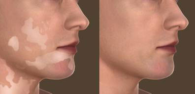 Treatment for Vitiligo Hyderabad | Vitiligo Specialist Clinic Hyderabad |  Skin Pigmentation Care